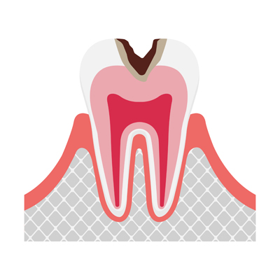 C2 中度のむし歯