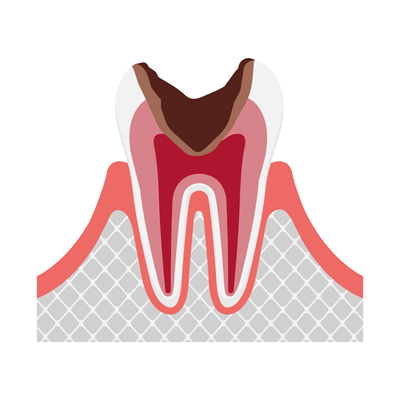 C3 重度のむし歯