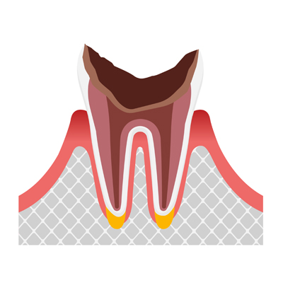 C4 最重度のむし歯