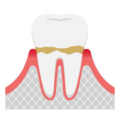 歯肉炎