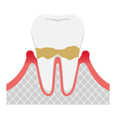 歯周炎（軽度）